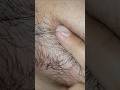Ingrown hair removal #asmr #satisfying #hairremoval #hairgrowth #treatment #massage #therapy #shorts