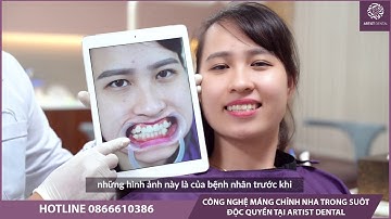 CÔNG NGHỆ CHỈNH NHA KHAY TRONG SUỐT ART CLEAR ALIGNER