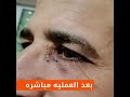 عمليات انسداد مجري الدمع المستعصية بنتائج فوريه 