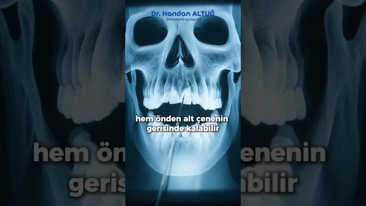 Çene Darlığı Nedir?