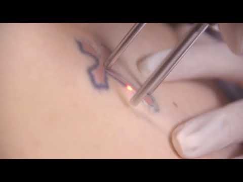 Tattoo Treatment with Enlighten Laser