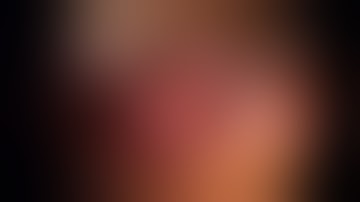 Laparaoscopic Transperitoneal Pyelolithotomy in Right Ectopic Pelvic Kidney