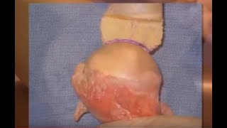 Distal Tibia Allograft for Glenoid Bone Loss: Dr. Provencher