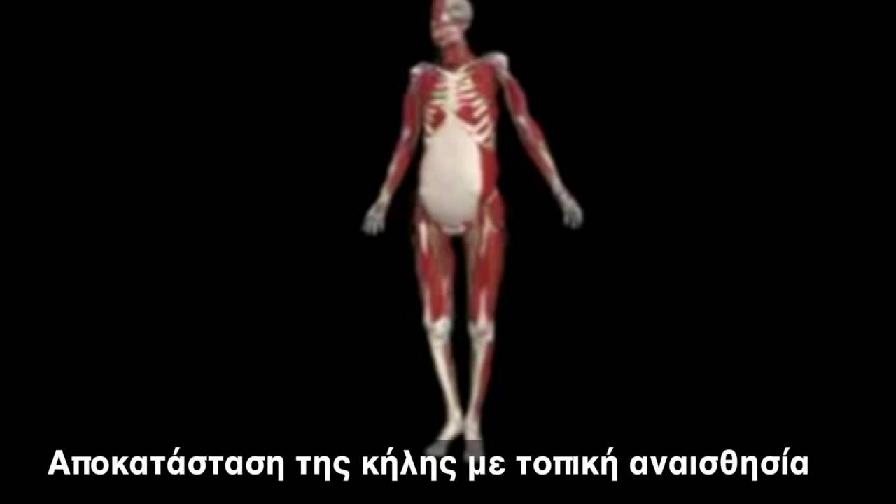 Αποκατάσταση της κήλης με τοπική αναισθησία