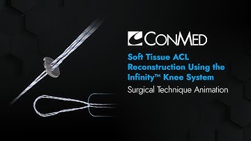 Soft Tissue ACL Reconstruction Using the Infinity™ Knee System - CONMED Animation