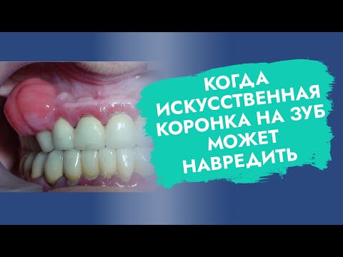 Коронки на зубы.