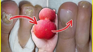 INCREDIBLE This HOME REMEDY DESTROYS Nail Fungus FAST Foot Fungus Natural Treatment