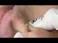 Blackheads And Pimples (Bình) P2 | Mụn Đầu Đen Ẩn Sâu Dưới Da (Bình) P2 - SacDepSpa#328