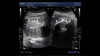 Ultrasound Video showing Two Fibroids, one is Calcified Fibroids.