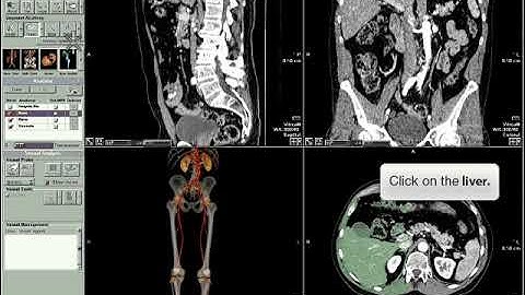 Vitrea Advanced segment organs demo