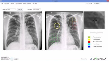 RiView (CAD for TB Detection from chest X-rays)