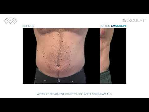 Emsculpt® - Waiting Room Video