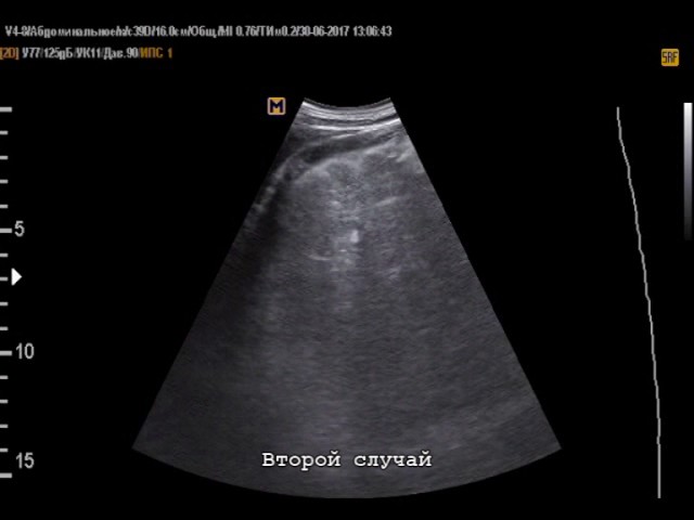 УЗИ брюшной полости - цирроз печени