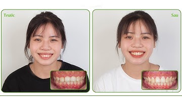 Phẫu thuật làm dài thân răng,  điều trị cười hở lợi - Nha Khoa Thùy Anh