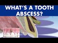 TOOTH ABSCESS dental infection - PHLEGMON symptoms and treatment ©