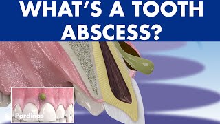 TOOTH ABSCESS dental infection  PHLEGMON symptoms and treatment ©