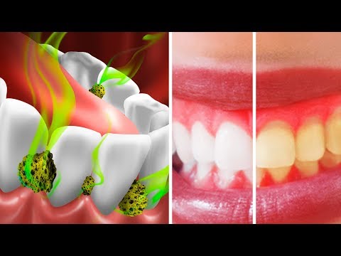 فيديو: كيفية استخدام الأعشاب لعلاج رائحة الفم الكريهة: 12 خطوة (بالصور)