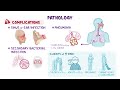 Influenza: Nursing