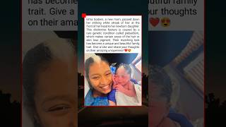 This Baby Inherited Her Moms Rare White Hair Known As Piebaldism