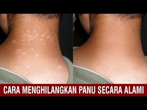Dr Oz Indonesia Cara Menghilangkan Panu - Bisabo Channel