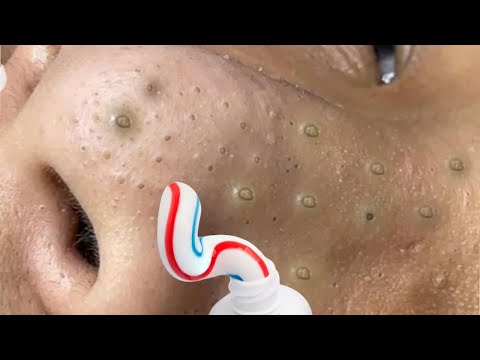 Remove blackheads in 5 minutes 🤩 a quick recipe to remove blackheads in one night 👍🏻