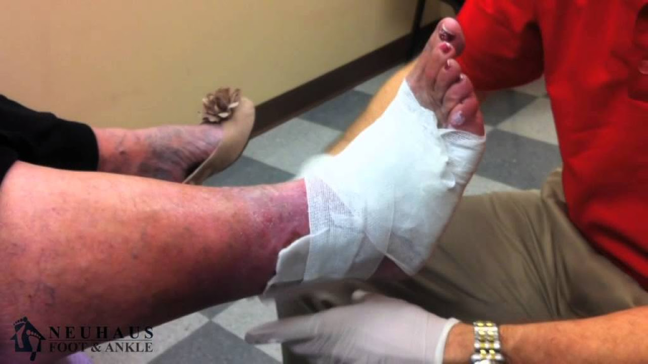 Treatment of an Ulcer with an Unna Boot