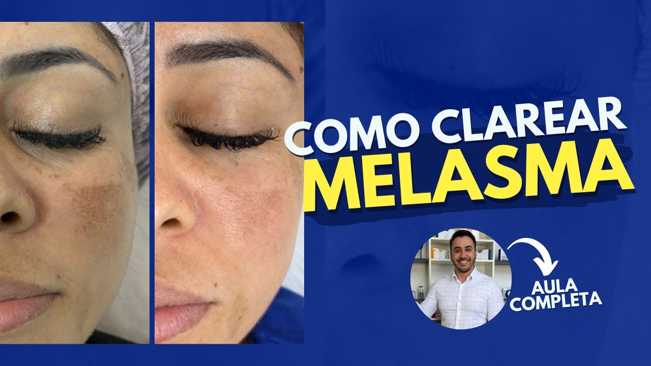 COMO CLAREAR O MELASMA COM MICROAGULHAMENTO - AULA COMPLETA - YouTube