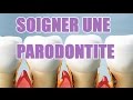 Inflammation des gencives parodontite - Explications sur cette maladie des gencives