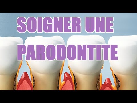 Inflammation des gencives parodontite - Explications sur cette maladie des gencives