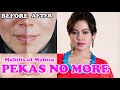 PAANO MATANGGAL ANG PEKAS O MELASMA | MABILIS AT MABISA