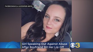 Woman Shares Emotional Journey After Ex-Boyfriend Bit Off Her Lip