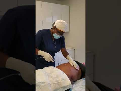 Tumescent Fluid To Numb The Treated Area For Liposuction
