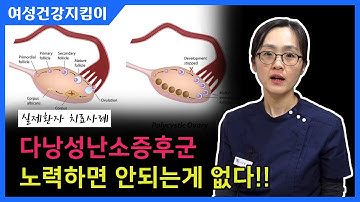 다낭성난소증후군 실제환자 치료 CASE !