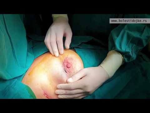 Операција карцинома дојке
