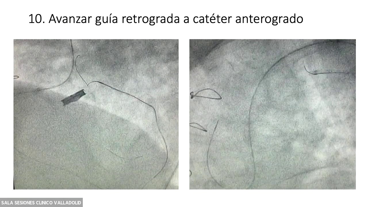 Virtual Best of Vall'Academy Retrograde access coronary chronic total occlusion