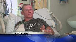 Download Lagu Virginia teen burned by hogweed MP3