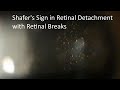 Shafers sign  tobacco dust or pigments in anterior vitreous in retinal detachment with breaks