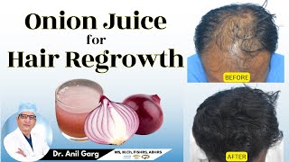 प्याज के रस गंजापन कैसे दूर करें? | Onion Juice: The Secret to Healthy Hair | Onion Juice For Hair