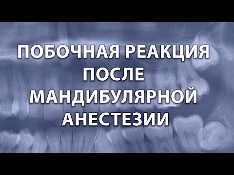 Побочная реакция после мандибулярной анестезии.