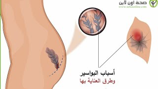 البواسير وكيف تتخلص منها ومن الالم المزعجHemorrhoids and how to get rid of them and the nagging pain