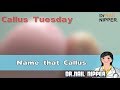 Toe Corns #10 - Callus Tuesday