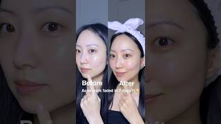 POV: You Found the Calmest Way to Treat Breakouts #acne
