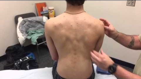 KT Tape Winging scapula (weak serratus anterior)