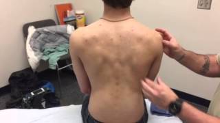 Kt Tape Winging Scapula Weak Serratus Anterior