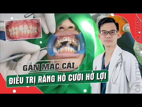 Video GẮN MẮC CÀI BẮT ĐẦU QUÁ TRÌNH NIỀNG RĂNG | Chỉnh nha... - youtube