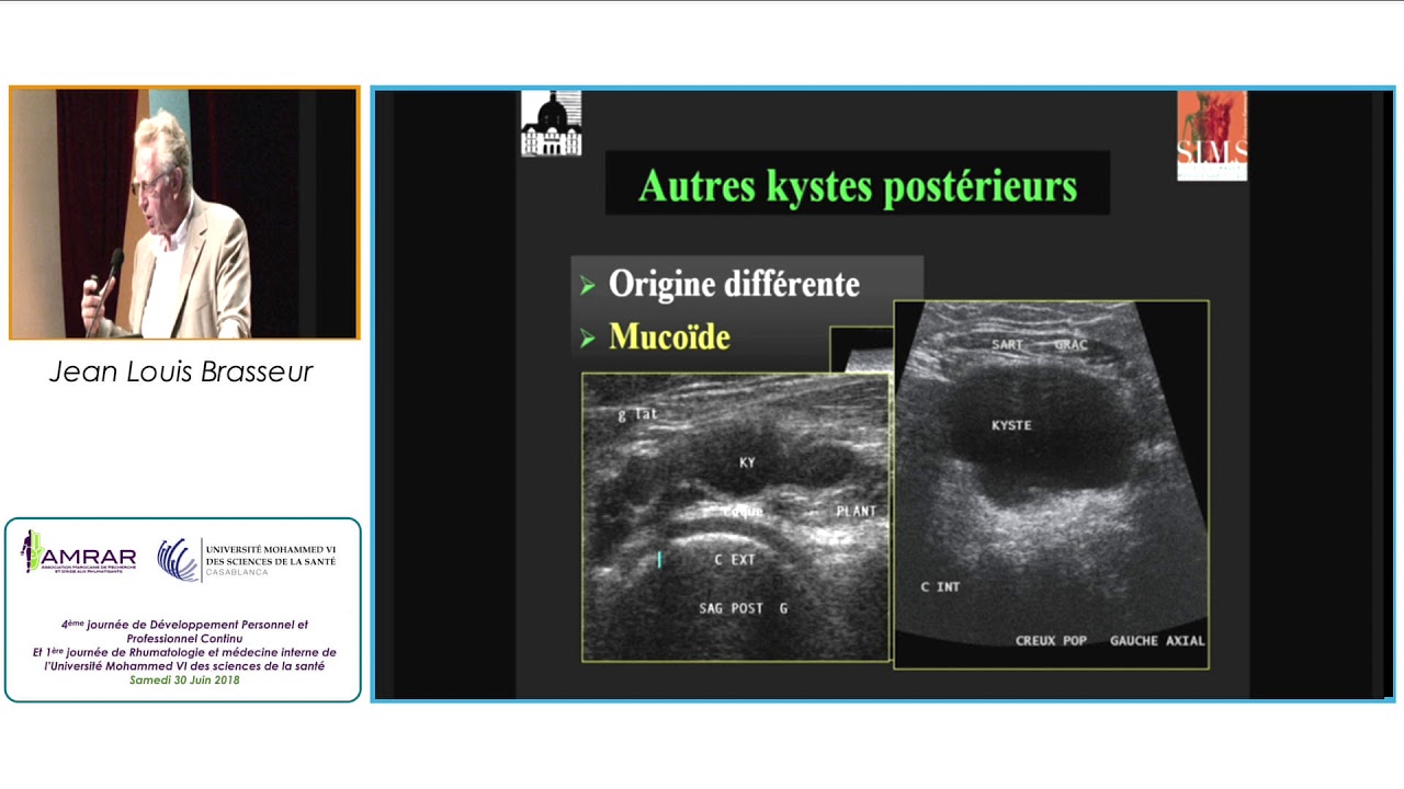 AMRAR - L'échographie du creux poplité, Jean Louis Brasseur - 300618