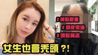 女生也會禿頭!頭頂稀疏細軟髮危機怎麼解決? 