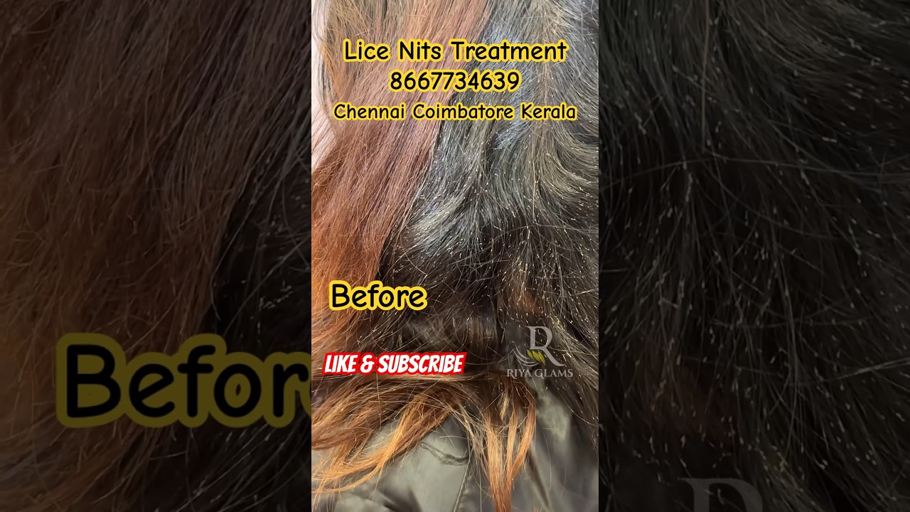 Lice nits removal treatment lice treatment lice removal lice how