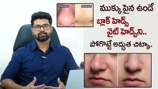 Whiteheads and Blackheads Removal Home Remedies | How to Remove Blackheads and Whiteheads Telugu