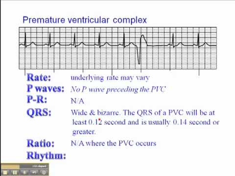 Ecg Premature Ventricular Complexes Pvc Youtube